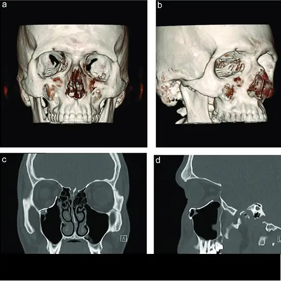 3D CT Maxillary Sinus